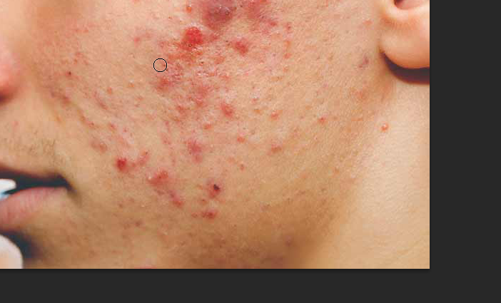remove acnes from the face photoshop