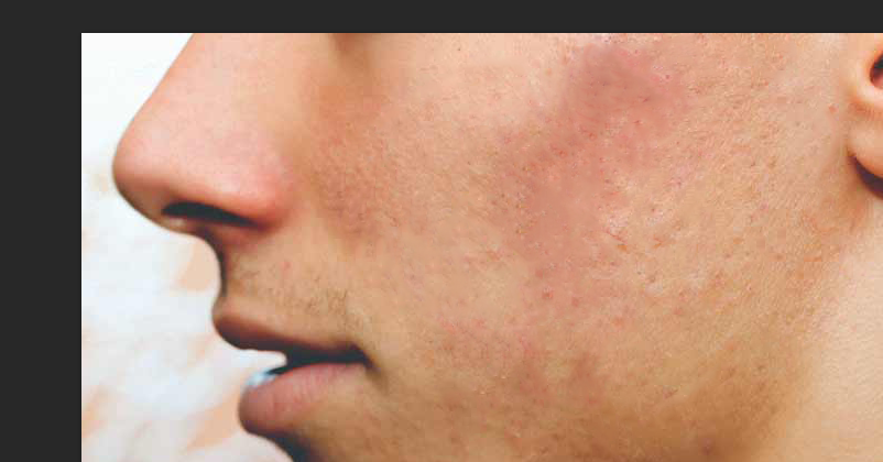 remove acnes from the face photoshop